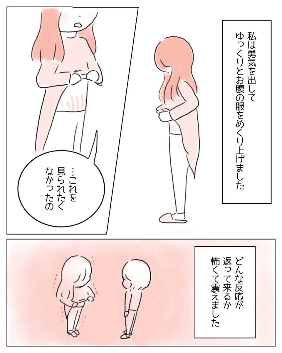 【夫に嫌われたくなくて…】妊娠線を隠す妻に夫がかけた言葉とは→「素敵すぎて泣けた」と読者から称賛の声