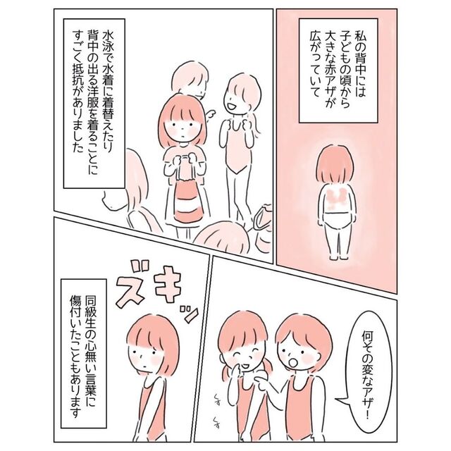 「みんな見てる…」“背中にアザ”がある私。背中の開いた服を着ると男性から声をかけられ…感激！
